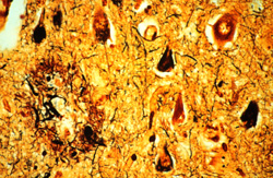 grovigli neurofibrillari