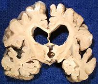 cervello alzheimer post mortem