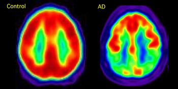cervello sano e cervello alzheimer alla pet